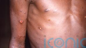HSE widening rollout of monkeypox vaccine to people at high risk