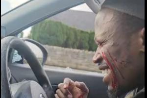 ‘The day the world went dark’: Dancer left blind after man smashed car window in Limerick