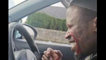 &lsquo;The day the world went dark&rsquo;: Dancer left blind after man smashed car window in Limerick