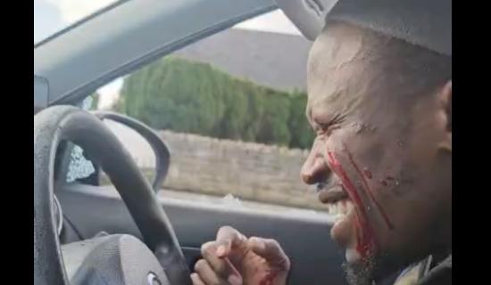 &lsquo;The day the world went dark&rsquo;: Dancer left blind after man smashed car window in Limerick