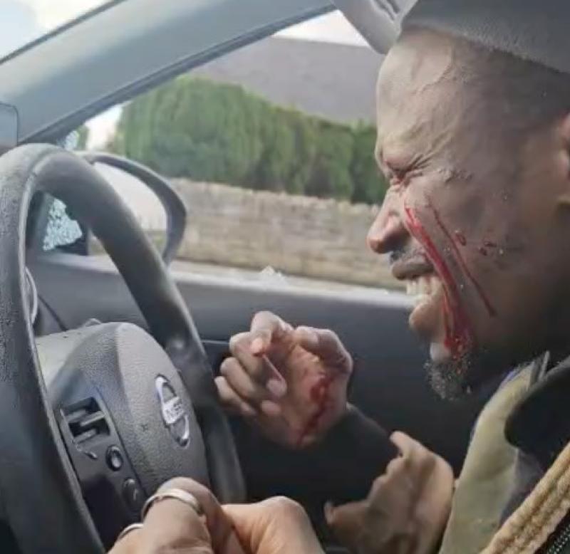 &lsquo;The day the world went dark&rsquo;: Dancer left blind after man smashed car window in Limerick