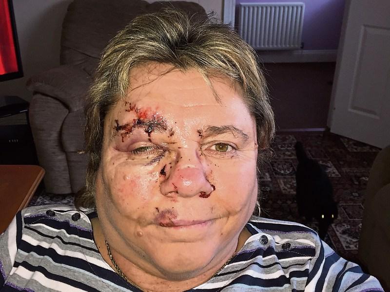 Limerick woman Leith Gath, who is a wheelchair user, was struck outside University Hospital Limerick